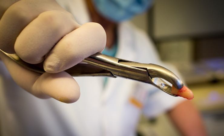 Ladro perde dente